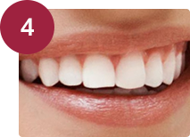 Implantes dentales