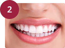 Implantes dentales