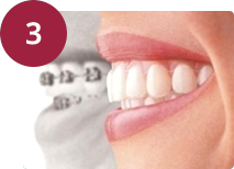 Implantes dentales